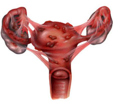 Endometrioza
